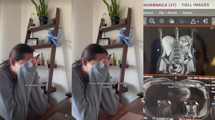 Kisah Pilu Wanita 13 Tahun Pakai KB, Berakhir Idap Tumor Hati