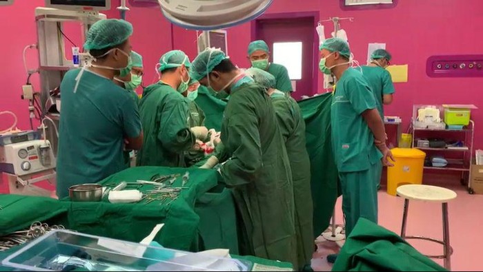 operasi bayi kembar siam di Malang operasi bayi kembar siam di Malang
