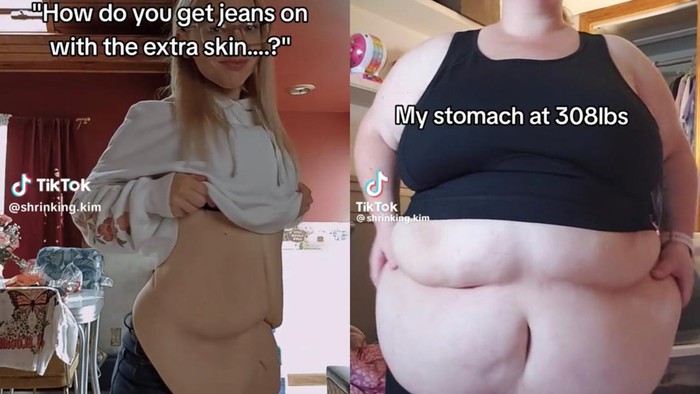 Viral Wanita Open Donasi Buat Biaya Operasi Kulit Gelambir usai Pangkas 80 Kg