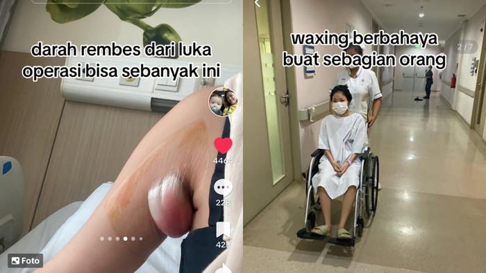 Dokter Kulit Bicara Viral Pemicu Efek Waxing Berujung Operasi Ketiak
