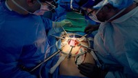 Cangkok ginjal babi ini dipimpin oleh Dr Robert Montgomery yang sebelumnya melakukan percobaan pertama di dunia transplantasi ginjal babi hasil rekayasa genetika di manusia pada 25 September 2021. (Foto: Joe Carrotta / NYU Langone Health)