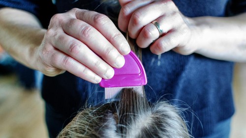 Ilustrasi Kutu Kepala pada Anak