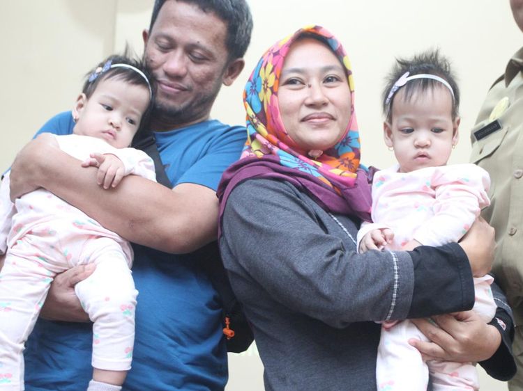 Berhasil Dipisahkan, Bayi Kembar Siam di Malang Akhirnya Pulang