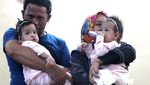 Berhasil Dipisahkan, Bayi Kembar Siam di Malang Akhirnya Pulang
