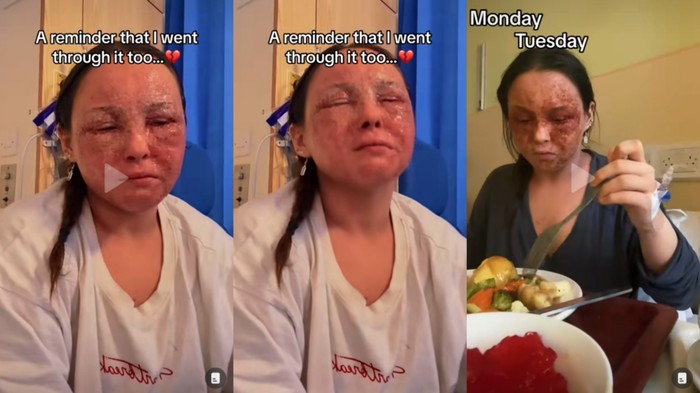 Wanita Ini Idap Eksim Parah, Kulitnya Sampai Melepuh Hingga Hampir Buta