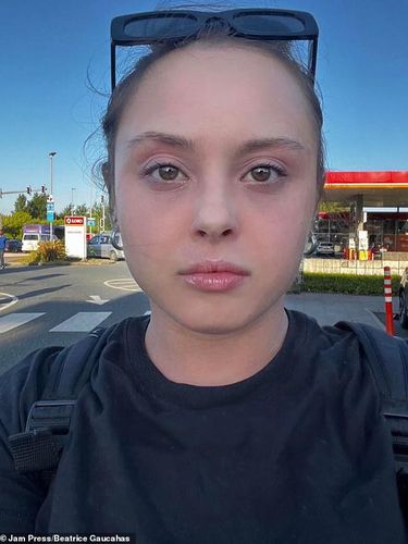 Wanita penderita eksim Wanita penderita eksim