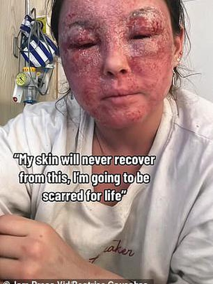 Wanita penderita eksim