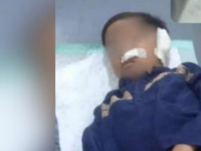 telinga bocah kota pasuruan putus digigit teman