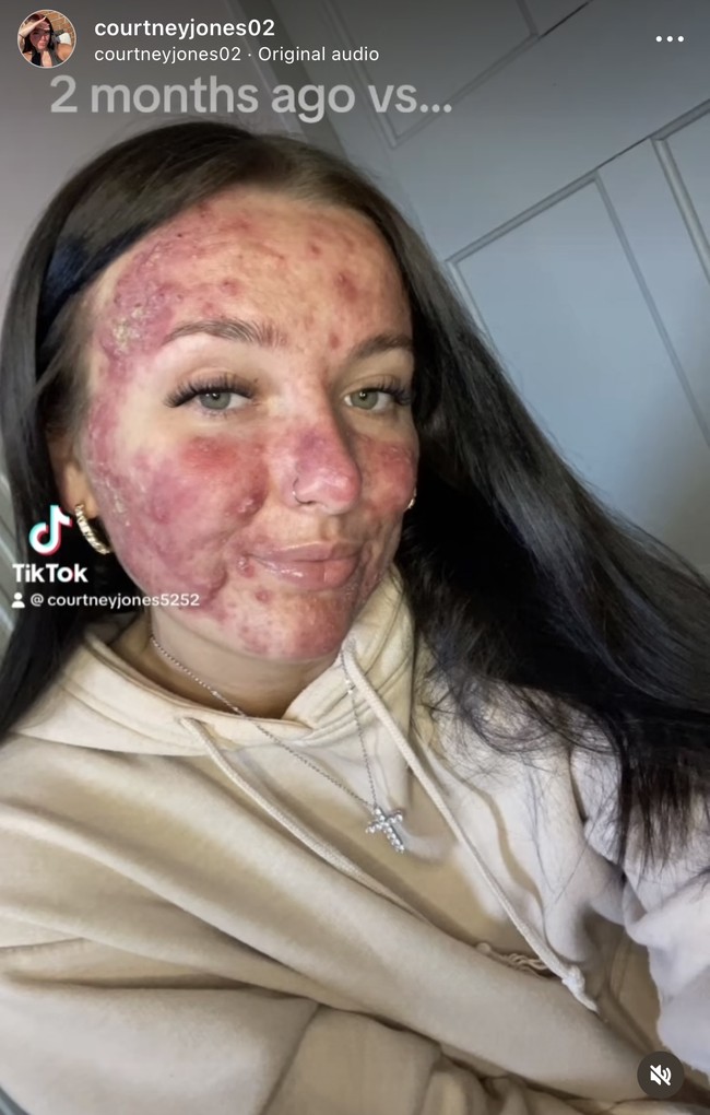 Courtney memiliki jerawat parah hingga meradang ke seluruh wajahnya. Inilah tampilan Courtney dengan wajah penuh jerawat.  Foto: Dok. Instagram/@courtneyjones02