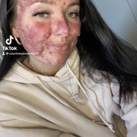 Courtney memiliki jerawat parah hingga meradang ke seluruh wajahnya. Inilah tampilan Courtney dengan wajah penuh jerawat.  Foto: Dok. Instagram/@courtneyjones02