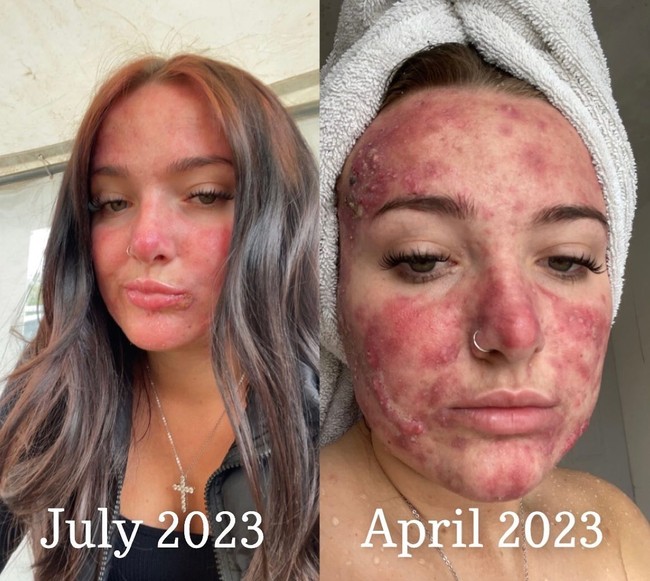 Pada bulan Mei, Courtney memulai pengobatan jerawat dari dalam. Dia menggunakan pil Accutane untuk meredakan jerawatnya. Dalam beberapa bulan ini tampak kulit Courtney semakin membaik.  Foto: Dok. Instagram/@courtneyjones02