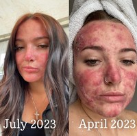 Pada bulan Mei, Courtney memulai pengobatan jerawat dari dalam. Dia menggunakan pil Accutane untuk meredakan jerawatnya. Dalam beberapa bulan ini tampak kulit Courtney semakin membaik.  Foto: Dok. Instagram/@courtneyjones02