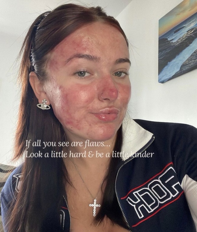 “Jerawat sangat menyakitkan secara mental dan fisik, itulah sebabnya aku ingin merangkulnya di TikTok dan menormalisasi agar orang lain tidak merasa sendirian,” ucap Courtney, seperti dikutip dari Need To Know. Foto: Dok. Instagram/@courtneyjones02