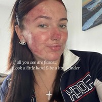 “Jerawat sangat menyakitkan secara mental dan fisik, itulah sebabnya aku ingin merangkulnya di TikTok dan menormalisasi agar orang lain tidak merasa sendirian,” ucap Courtney, seperti dikutip dari Need To Know. Foto: Dok. Instagram/@courtneyjones02