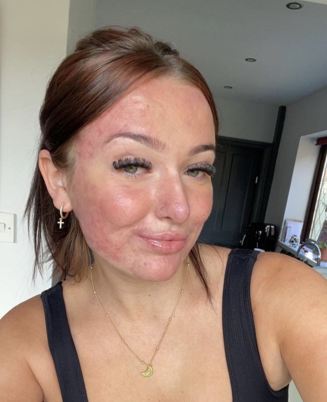 Berbagi kerentanannya di dunia maya telah membuatnya mendapatkan pengikut dalam jumlah besar sebanyak 996.000 pengikut di TikTok. Para penderita jerawat berbondong-bondong mengunjungi bagian komentarnya untuk memuji transparansinya, sementara yang lain meminta nasihat. Foto: Dok. Instagram/@courtneyjones02