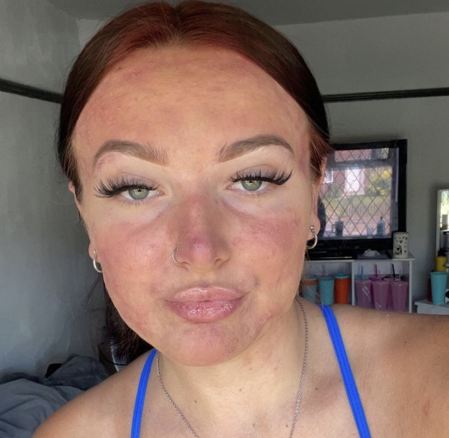 Tampak perubahan before dan after setelah meminum pil tersebut. “Aku sudah menjalani pengobatan ini selama hampir tiga bulan dan hasilnya luar biasa, kulitku akhirnya bersih dan aku jauh lebih percaya diri,” aku Courtney.  Foto: Dok. Instagram/@courtneyjones02