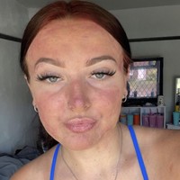 Tampak perubahan before dan after setelah meminum pil tersebut. “Aku sudah menjalani pengobatan ini selama hampir tiga bulan dan hasilnya luar biasa, kulitku akhirnya bersih dan aku jauh lebih percaya diri,” aku Courtney.  Foto: Dok. Instagram/@courtneyjones02