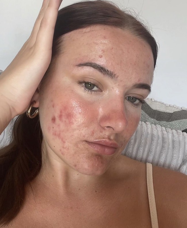 Courtney Jones mencoba bersahabat dengan jerawatnya yang telah ada sejak ia remaja. Wanita 21 tahun itu mencoba mengendalikan perasaan tidak percaya dirinya dengan membuat konten tentang jerawat. Foto: Dok. Instagram/@courtneyjones02