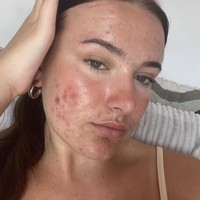 Courtney Jones mencoba bersahabat dengan jerawatnya yang telah ada sejak ia remaja. Wanita 21 tahun itu mencoba mengendalikan perasaan tidak percaya dirinya dengan membuat konten tentang jerawat. Foto: Dok. Instagram/@courtneyjones02