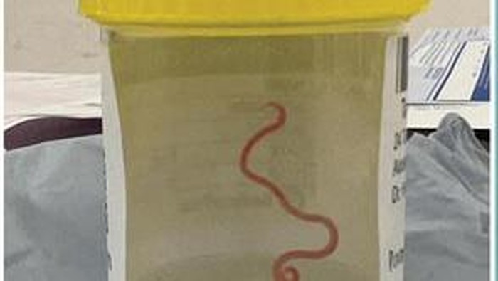 Heboh Cacing Hidup di Otak Bikin Wanita Ini Sering Lupa, Begini Awal Mulanya