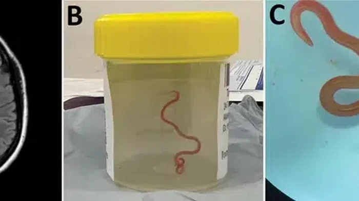 Penampakan Cacing Hidup 8 Cm Bersarang di Otak, Jadi Kasus Pertama di Dunia