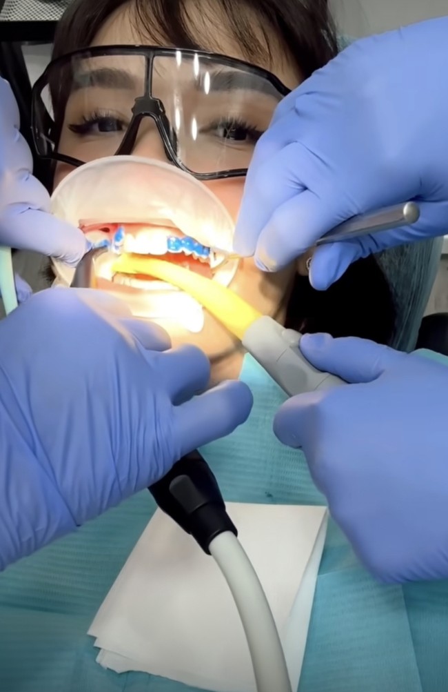 Perawatan giginya dimulai pada Juni 2023 dan kini masih dalam proses. Banyak netizen yang menyayangkan keputusan melepas gigi gingsul. Foto: Instagram @chelseaoliviaa