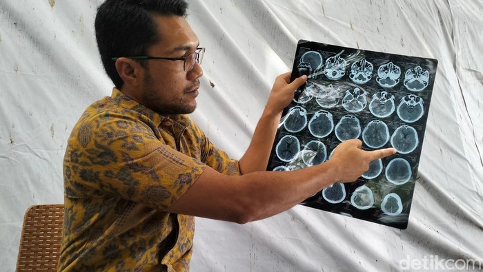 Hasil CT scan siswa di Banda Aceh yang diduga dikeroyok abang kelas