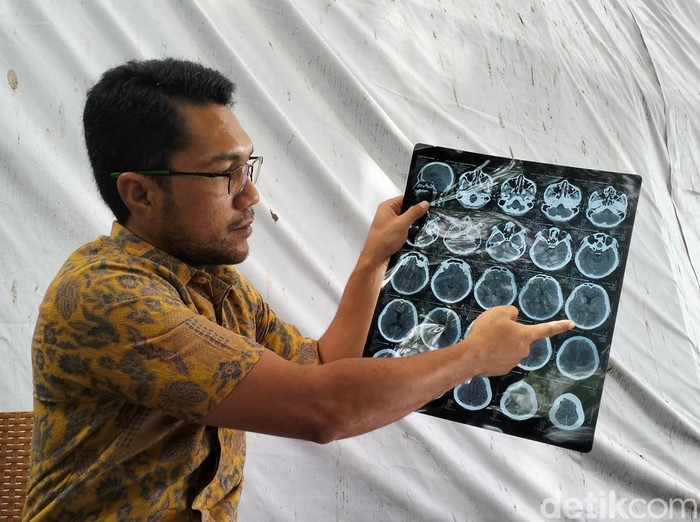 Hasil CT scan siswa di Banda Aceh yang diduga dikeroyok abang kelas