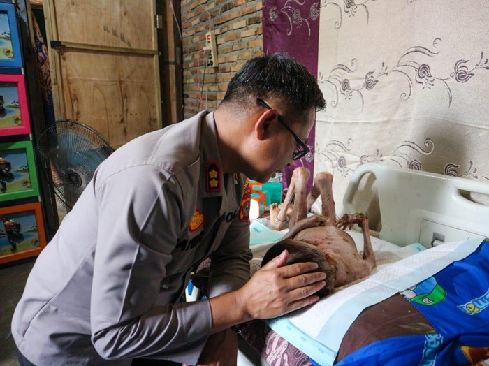 AKBP Catur Sungkowo, S.Ag, S.H., M.H melihat kondisi Prasetia bocah 5 tahun yang menderita sakit. Dokumen Polres Labusel