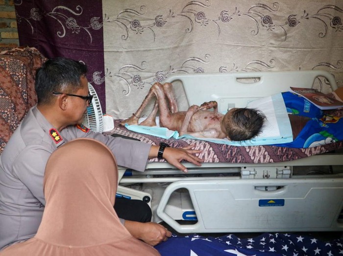 Miris nasib balita Prasetia Bilal Ramadhan (5), karena kurang biaya, harus menanggung sakit kulit selama 3 tahun. Dokumen Polres Labusel