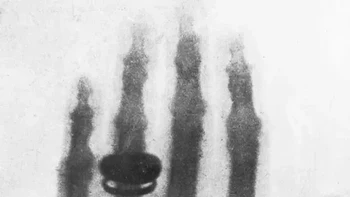 Hasil rontgen ini yang diambil oleh Wilhelm Conrad Röntgen. Ini adalah rontgen pertama yang pernah ada: Foto: Buzzfeed