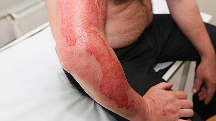 Patient with first-degree burn