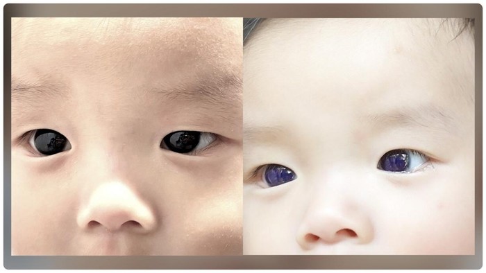 Viral Mata Bayi di Thailand Berubah Jadi Biru usai Perawatan COVID-19