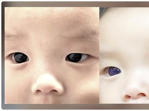 Viral Mata Bayi di Thailand Berubah Jadi Biru usai Perawatan COVID-19