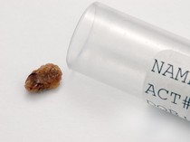 Ini yang Terjadi Pada Tubuh saat Terkena Penyakit Batu Ginjal