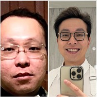 Dokter Richard juga mengaku jika dirinya dulu sempat mengalami masalah jerawat. Jerawat tersebut yang kemudian meninggalkan bekas, seperti bopeng di wajahnya. Foto: Instagram/@dr.richard_lee