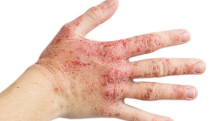 Eksim Basah, Bagaimana Cara Mengobati dan Merawatnya?