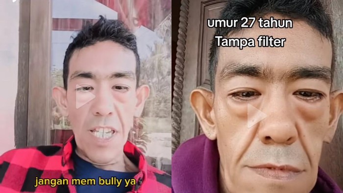 Curhat Pria Aceh Kena Sindrom Langka, Wajah Tua Dikira Pakai Filter