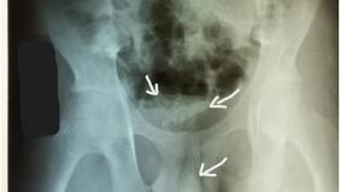 Ngilu, Kabel 20 Cm Nyangkut di Mr P Remaja gegara Fetish Ekstrem