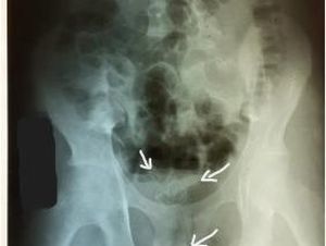 Ngilu, Kabel 20 Cm Nyangkut di Mr P Remaja gegara Fetish Ekstrem