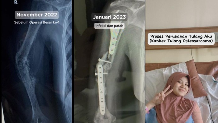 Wanita di Bandung Idap Kanker Tulang, Dokter Ingatkan Jangan Asal Urut kalau Pegal