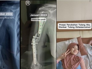Wanita di Bandung Idap Kanker Tulang, Dokter Ingatkan Jangan Asal Urut kalau Pegal