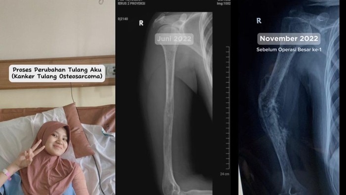 Cerita Wanita Ketahuan Kena Kanker Tulang gegara Sering Pegal-pegal