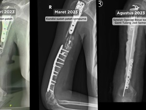 Kisah Lengkap Wanita Bandung Idap Kanker Tulang, Inikah Pemicunya?