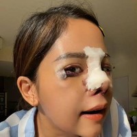 Pada 2021, food vlogger Farida Nurhan mengakui bahwa dia melakukan operasi hidung yang ditangani oleh dr Tompi. Farida mengaku bahwa telah melakukan operasi hidung sebanyak tiga kali yakni beberapa tahun silam, operasi kedua pada 2020 dan rhinoplasty (operasi hidung) ketiga pqda 2021. Foto: dok. Instagram/@farida.nurhan
