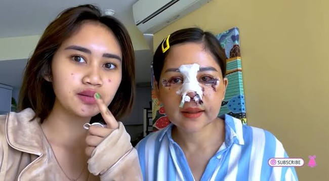Tak hanya hidung, kala itu Farida juga melakukan operasi kantung mata. Inilah wajah lebamnya setelah tiga hari operasi. Dalam momen tersebut, Farida ditemani  putrinya Diaz. Foto: dok. Instagram/@farida.nurhan