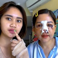 Tak hanya hidung, kala itu Farida juga melakukan operasi kantung mata. Inilah wajah lebamnya setelah tiga hari operasi. Dalam momen tersebut, Farida ditemani  putrinya Diaz. Foto: dok. Instagram/@farida.nurhan