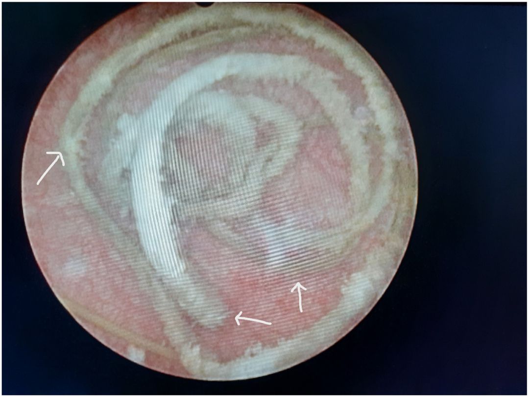 Penampakan kabel yang nyangkut di Mr P remaja di Sri Lanka Penampakan kabel yang nyangkut di Mr P remaja di Sri Lanka