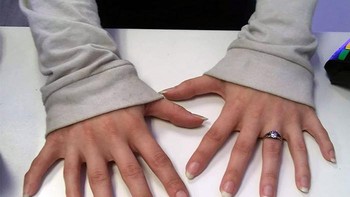 Tangan Yang Masing-masing Memiliki 6 Jari Foto: Boredpanda