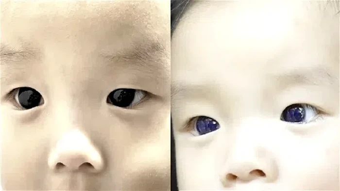 Mata cokelat yang dimiliki bayi berusia enam bulan di Thailand berubah menjadi biru indigo setelah menjalani perawatan COVID-19.